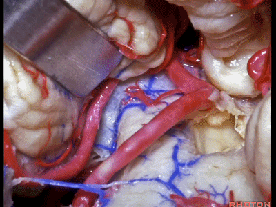 外展枕怎么使用脑干解剖及相关入路---Rhoton解剖视频学习笔记系列_https://www.jmylbn.com_新闻资讯_第257张