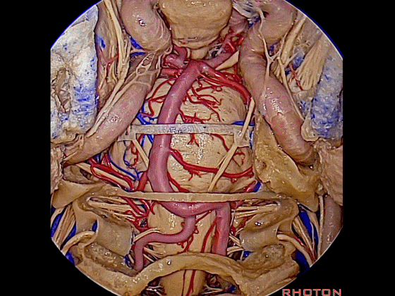 外展枕怎么使用脑干解剖及相关入路---Rhoton解剖视频学习笔记系列_https://www.jmylbn.com_新闻资讯_第360张