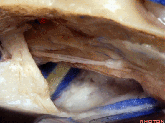 外展枕怎么使用脑干解剖及相关入路---Rhoton解剖视频学习笔记系列_https://www.jmylbn.com_新闻资讯_第191张