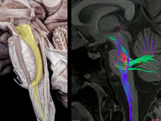 外展枕怎么使用脑干解剖及相关入路---Rhoton解剖视频学习笔记系列_https://www.jmylbn.com_新闻资讯_第8张