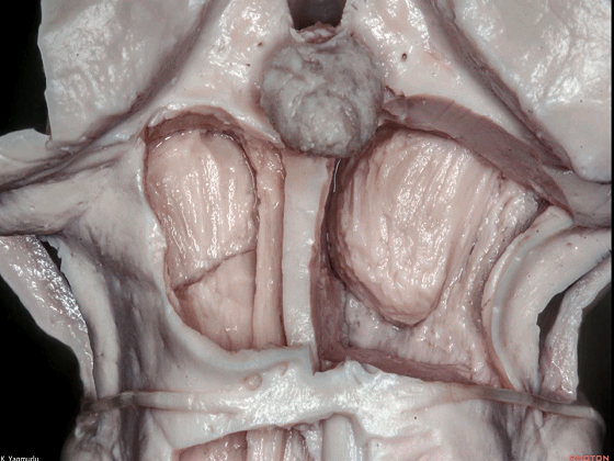 外展枕怎么使用脑干解剖及相关入路---Rhoton解剖视频学习笔记系列_https://www.jmylbn.com_新闻资讯_第81张