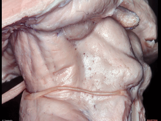 外展枕怎么使用脑干解剖及相关入路---Rhoton解剖视频学习笔记系列_https://www.jmylbn.com_新闻资讯_第62张