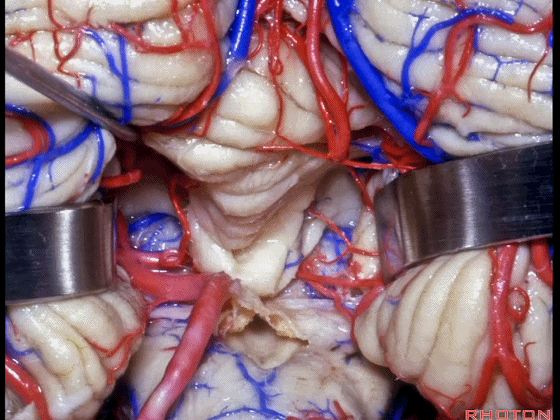 外展枕怎么使用脑干解剖及相关入路---Rhoton解剖视频学习笔记系列_https://www.jmylbn.com_新闻资讯_第244张