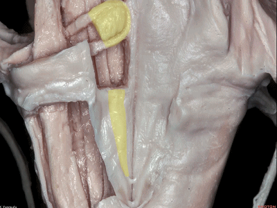 外展枕怎么使用脑干解剖及相关入路---Rhoton解剖视频学习笔记系列_https://www.jmylbn.com_新闻资讯_第129张