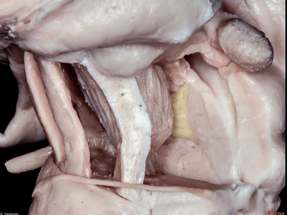 外展枕怎么使用脑干解剖及相关入路---Rhoton解剖视频学习笔记系列_https://www.jmylbn.com_新闻资讯_第85张