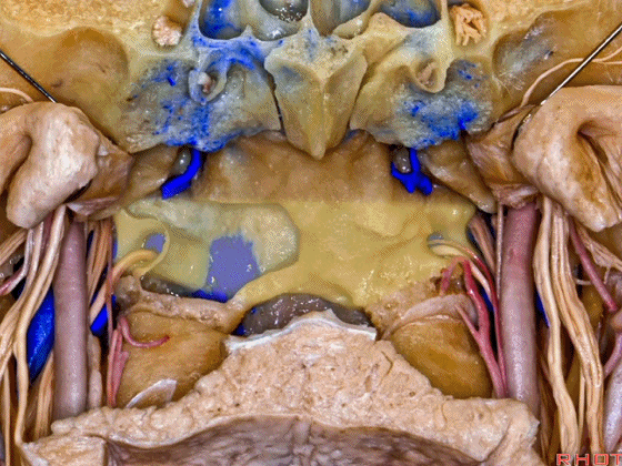 外展枕怎么使用脑干解剖及相关入路---Rhoton解剖视频学习笔记系列_https://www.jmylbn.com_新闻资讯_第333张
