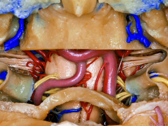 外展枕怎么使用脑干解剖及相关入路---Rhoton解剖视频学习笔记系列_https://www.jmylbn.com_新闻资讯_第338张