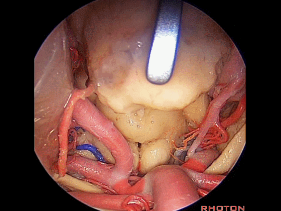 外展枕怎么使用脑干解剖及相关入路---Rhoton解剖视频学习笔记系列_https://www.jmylbn.com_新闻资讯_第351张