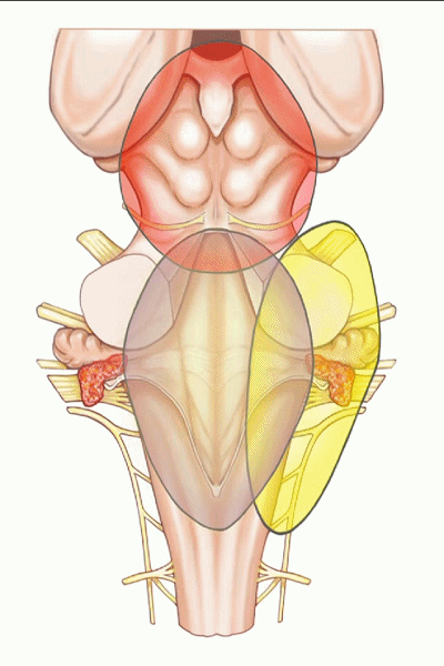 外展枕怎么使用脑干解剖及相关入路---Rhoton解剖视频学习笔记系列_https://www.jmylbn.com_新闻资讯_第232张