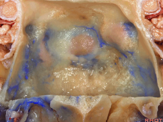 外展枕怎么使用脑干解剖及相关入路---Rhoton解剖视频学习笔记系列_https://www.jmylbn.com_新闻资讯_第341张