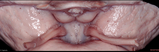外展枕怎么使用脑干解剖及相关入路---Rhoton解剖视频学习笔记系列_https://www.jmylbn.com_新闻资讯_第49张