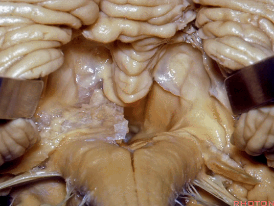 外展枕怎么使用脑干解剖及相关入路---Rhoton解剖视频学习笔记系列_https://www.jmylbn.com_新闻资讯_第237张