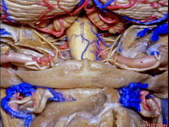 外展枕怎么使用脑干解剖及相关入路---Rhoton解剖视频学习笔记系列_https://www.jmylbn.com_新闻资讯_第321张