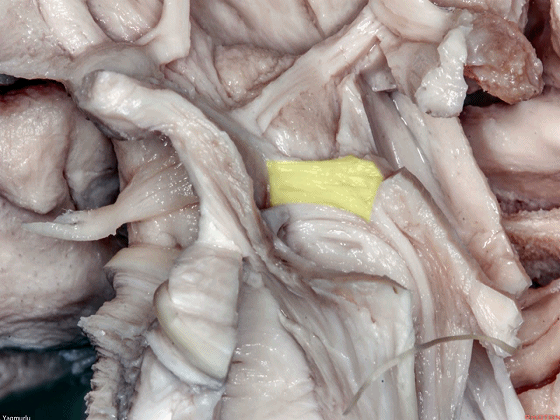 外展枕怎么使用脑干解剖及相关入路---Rhoton解剖视频学习笔记系列_https://www.jmylbn.com_新闻资讯_第54张