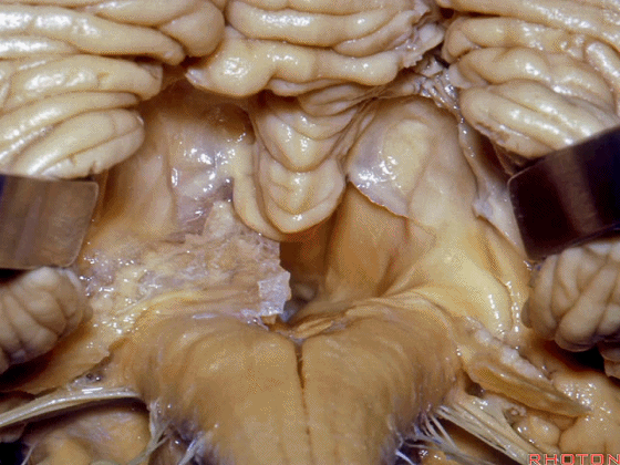 外展枕怎么使用脑干解剖及相关入路---Rhoton解剖视频学习笔记系列_https://www.jmylbn.com_新闻资讯_第242张