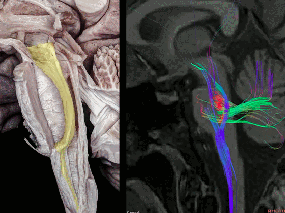 外展枕怎么使用脑干解剖及相关入路---Rhoton解剖视频学习笔记系列_https://www.jmylbn.com_新闻资讯_第7张