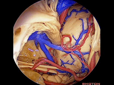 外展枕怎么使用脑干解剖及相关入路---Rhoton解剖视频学习笔记系列_https://www.jmylbn.com_新闻资讯_第363张