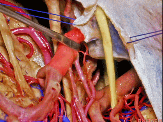 外展枕怎么使用脑干解剖及相关入路---Rhoton解剖视频学习笔记系列_https://www.jmylbn.com_新闻资讯_第206张