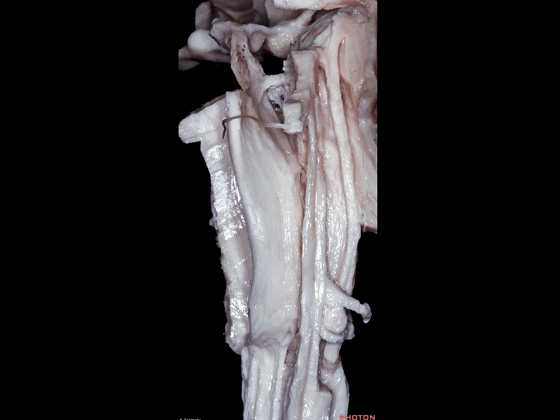 外展枕怎么使用脑干解剖及相关入路---Rhoton解剖视频学习笔记系列_https://www.jmylbn.com_新闻资讯_第17张