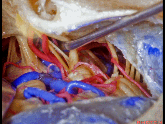 外展枕怎么使用脑干解剖及相关入路---Rhoton解剖视频学习笔记系列_https://www.jmylbn.com_新闻资讯_第283张