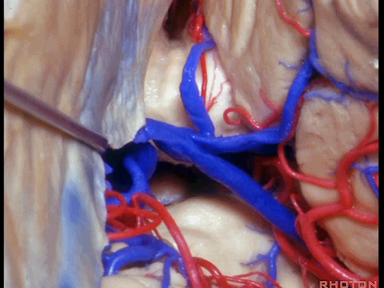 外展枕怎么使用脑干解剖及相关入路---Rhoton解剖视频学习笔记系列_https://www.jmylbn.com_新闻资讯_第230张