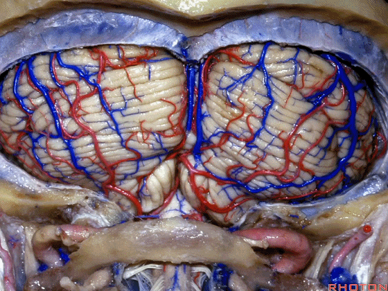 外展枕怎么使用脑干解剖及相关入路---Rhoton解剖视频学习笔记系列_https://www.jmylbn.com_新闻资讯_第243张