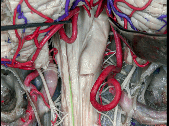 外展枕怎么使用脑干解剖及相关入路---Rhoton解剖视频学习笔记系列_https://www.jmylbn.com_新闻资讯_第142张