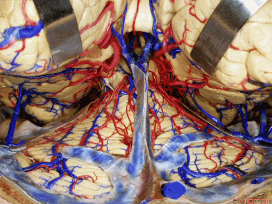 外展枕怎么使用脑干解剖及相关入路---Rhoton解剖视频学习笔记系列_https://www.jmylbn.com_新闻资讯_第211张
