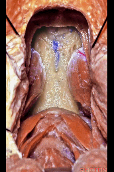外展枕怎么使用脑干解剖及相关入路---Rhoton解剖视频学习笔记系列_https://www.jmylbn.com_新闻资讯_第312张