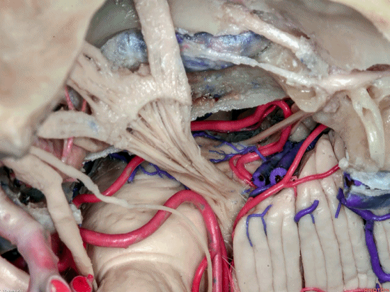 外展枕怎么使用脑干解剖及相关入路---Rhoton解剖视频学习笔记系列_https://www.jmylbn.com_新闻资讯_第95张