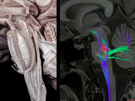 外展枕怎么使用脑干解剖及相关入路---Rhoton解剖视频学习笔记系列_https://www.jmylbn.com_新闻资讯_第9张