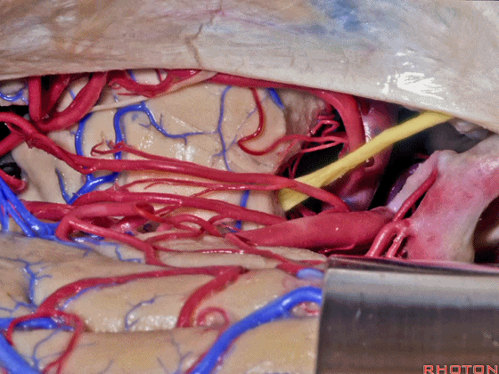 外展枕怎么使用脑干解剖及相关入路---Rhoton解剖视频学习笔记系列_https://www.jmylbn.com_新闻资讯_第175张