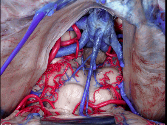 外展枕怎么使用脑干解剖及相关入路---Rhoton解剖视频学习笔记系列_https://www.jmylbn.com_新闻资讯_第75张