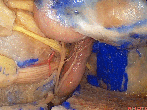 外展枕怎么使用脑干解剖及相关入路---Rhoton解剖视频学习笔记系列_https://www.jmylbn.com_新闻资讯_第345张