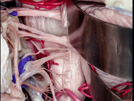 外展枕怎么使用脑干解剖及相关入路---Rhoton解剖视频学习笔记系列_https://www.jmylbn.com_新闻资讯_第93张