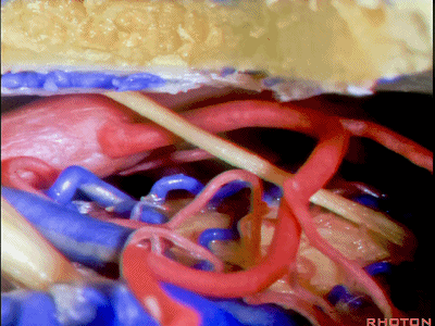 外展枕怎么使用脑干解剖及相关入路---Rhoton解剖视频学习笔记系列_https://www.jmylbn.com_新闻资讯_第290张