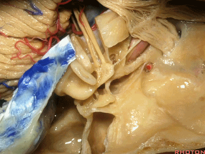 外展枕怎么使用脑干解剖及相关入路---Rhoton解剖视频学习笔记系列_https://www.jmylbn.com_新闻资讯_第184张