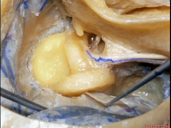 外展枕怎么使用脑干解剖及相关入路---Rhoton解剖视频学习笔记系列_https://www.jmylbn.com_新闻资讯_第282张