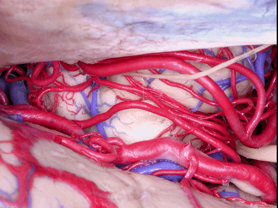 外展枕怎么使用脑干解剖及相关入路---Rhoton解剖视频学习笔记系列_https://www.jmylbn.com_新闻资讯_第58张