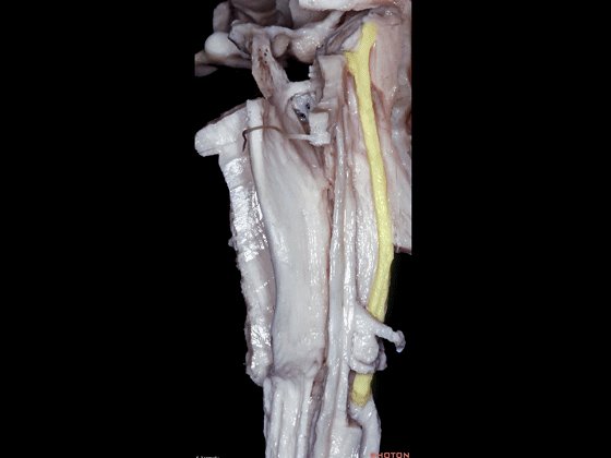 外展枕怎么使用脑干解剖及相关入路---Rhoton解剖视频学习笔记系列_https://www.jmylbn.com_新闻资讯_第21张