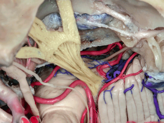 外展枕怎么使用脑干解剖及相关入路---Rhoton解剖视频学习笔记系列_https://www.jmylbn.com_新闻资讯_第96张