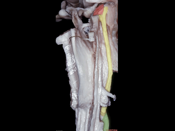 外展枕怎么使用脑干解剖及相关入路---Rhoton解剖视频学习笔记系列_https://www.jmylbn.com_新闻资讯_第22张