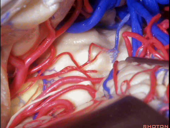 外展枕怎么使用脑干解剖及相关入路---Rhoton解剖视频学习笔记系列_https://www.jmylbn.com_新闻资讯_第223张