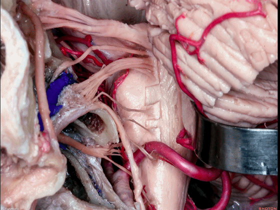 外展枕怎么使用脑干解剖及相关入路---Rhoton解剖视频学习笔记系列_https://www.jmylbn.com_新闻资讯_第133张