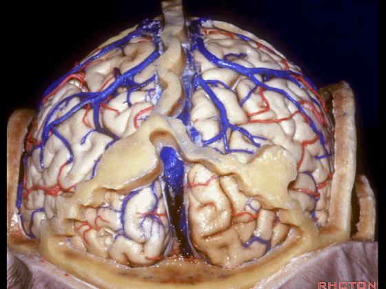 外展枕怎么使用脑干解剖及相关入路---Rhoton解剖视频学习笔记系列_https://www.jmylbn.com_新闻资讯_第225张