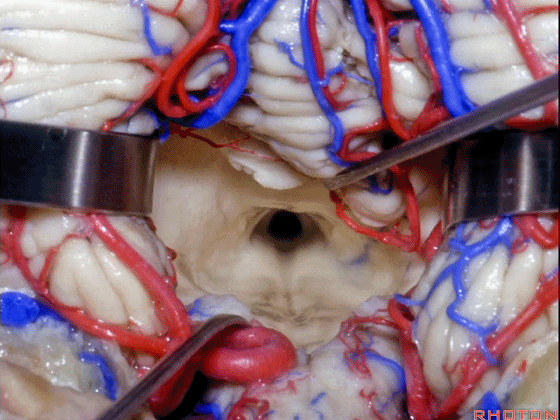 外展枕怎么使用脑干解剖及相关入路---Rhoton解剖视频学习笔记系列_https://www.jmylbn.com_新闻资讯_第250张