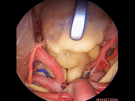 外展枕怎么使用脑干解剖及相关入路---Rhoton解剖视频学习笔记系列_https://www.jmylbn.com_新闻资讯_第350张