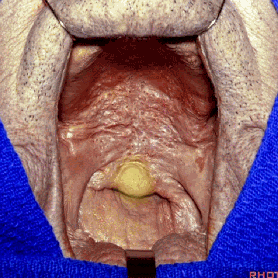 外展枕怎么使用脑干解剖及相关入路---Rhoton解剖视频学习笔记系列_https://www.jmylbn.com_新闻资讯_第309张