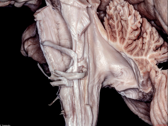 外展枕怎么使用脑干解剖及相关入路---Rhoton解剖视频学习笔记系列_https://www.jmylbn.com_新闻资讯_第104张