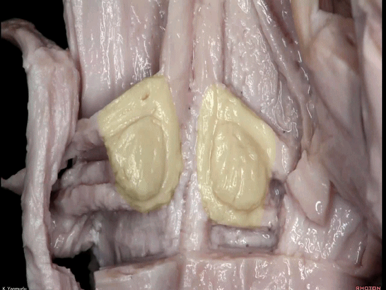 外展枕怎么使用脑干解剖及相关入路---Rhoton解剖视频学习笔记系列_https://www.jmylbn.com_新闻资讯_第109张